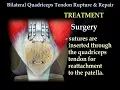 Bilateral Quadriceps Tendon Rupture Repair Everything You Need To Know Dr Nabil Ebraheim