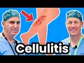 Cellulitis Explained By Infectious Disease Doc Red Sore And Swollen