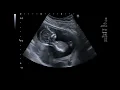 Beautiful Ultrasound of 14 Weeks Pregnancy Baby Girl