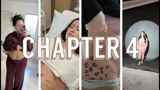 Tummy Tuck Journey - Ch 4 Three Weeks Post-Op