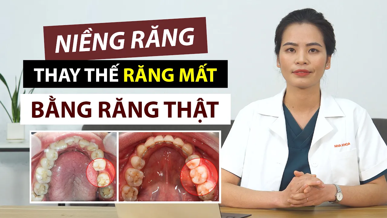 Outline Video THAY THẾ RĂNG MẤT BẰNG RĂNG THẬT NHỜ CHỈNH NHA – Kéo khít lại khoảng trống mất răng