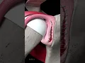 Shoulder Labrum Tear Repair Animation