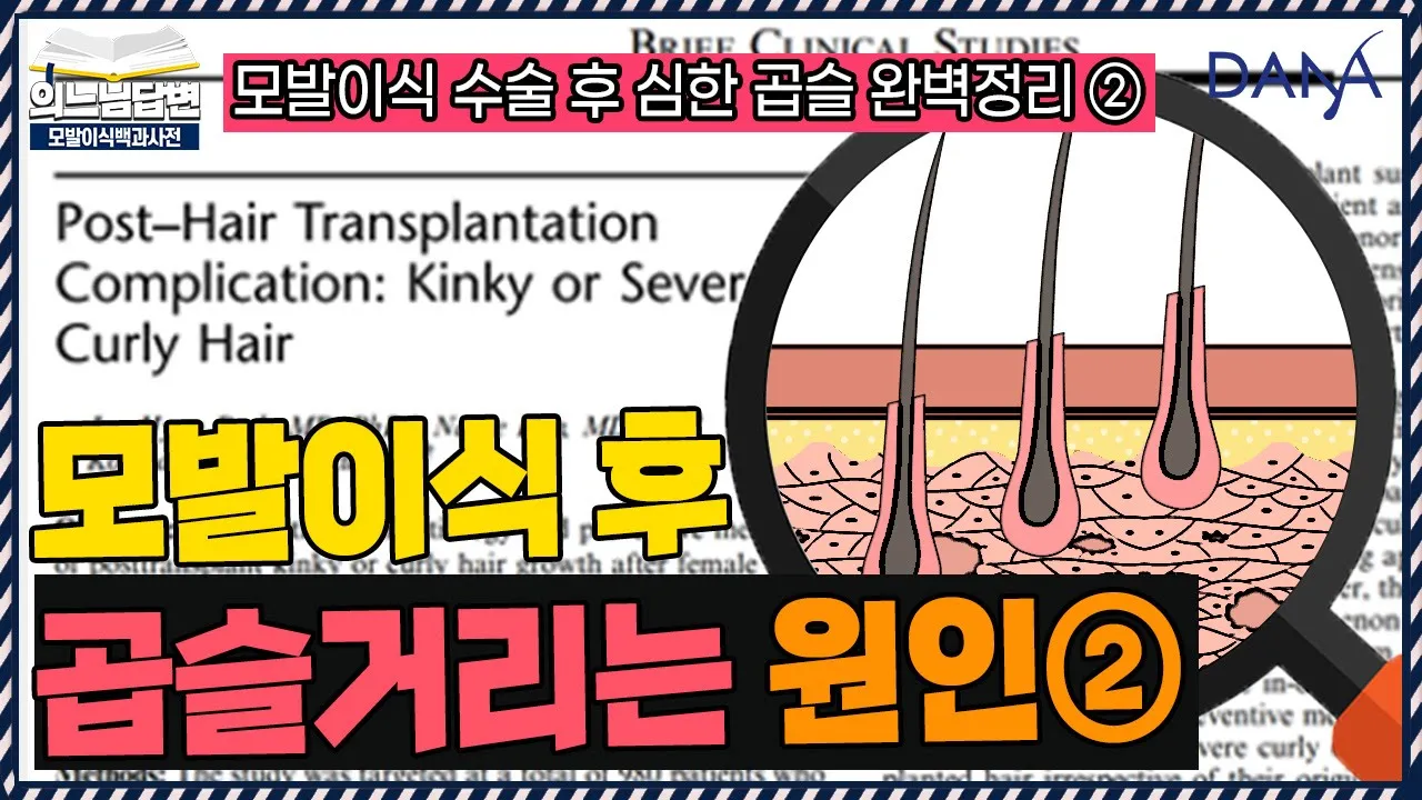 의느님답변📂모낭 이식 시 깊이 조절의 중요성!!ㅣ모발이식 수술 후 심한 곱슬 완벽정리②ㅣ다나성형외과(DANA)ㅣ모발이식ㅣ헤어라인교정ㅣ두피문신ㅣ탈모치료
