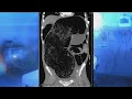 Man s Extreme Constipation Nearly Kills Him