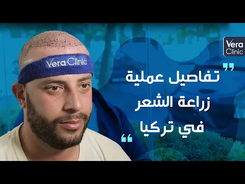 زراعة الشعر في تركيا في مشفى فيرا كلينيك