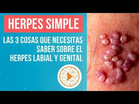 Download MP3 HERPES SIMPLE | Las 3 cosas que necesitas saber sobre el herpes labial y genital