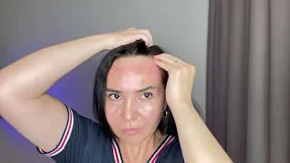 One Powerful Technique to eliminate stubborn Forehead Wrinkles 