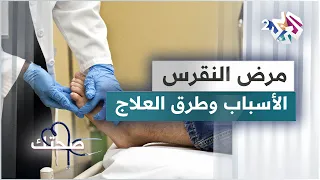 مرض النقرس التشخيص وطرق العلاج 