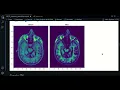 2 0 - Denoise morphological operations ANTsPy