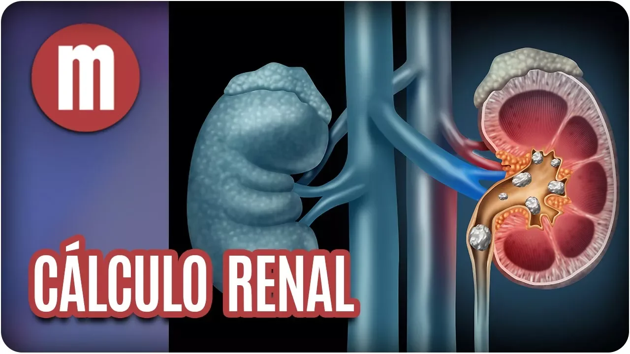 REMÉDIO CASEIRO PARA ARTRITE - ARTROSE E DORES NAS JUNTAS  - Culinária em Casa