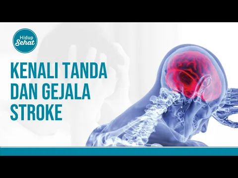 Kenali Gejala Stroke dan Pahami Cara Mencegahnya Sejak Dini!