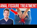 Download Lagu 10 Tips to Help With Anal Fissure Symptoms