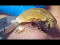 Download Lagu Thick Onychomycosis Becomes Curved, Carefully Remove【Pedicure Master Lin Jun】