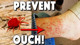 What Are Chiggers How To Treat Bites And How To Prevent