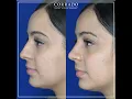 Nose Job Before and After Female Pictures Dr Anthony Corrado