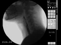 Nectar Thick Liquids - Modified Barium Swallow Study MBSS Lateral View