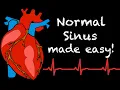 EMS Cardiology Tachy Tuesday Normal Sinus Rhythm NSR