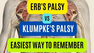 Erb s Palsy Vs Klumpke s Palsy Brachial Plexus Injury Easy Way To Remember