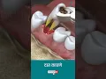 Download Lagu दात काढण्याची प्रक्रिया ↪ 3D Medical Animation #Shorts #Tooth #ToothExtraction