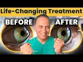 Don t Get a Corneal Transplant Until You See This Keratoconus Treatment
