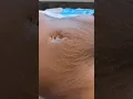 Stretch Marks Inkless Removal Boleyn Treatment Los Angeles
