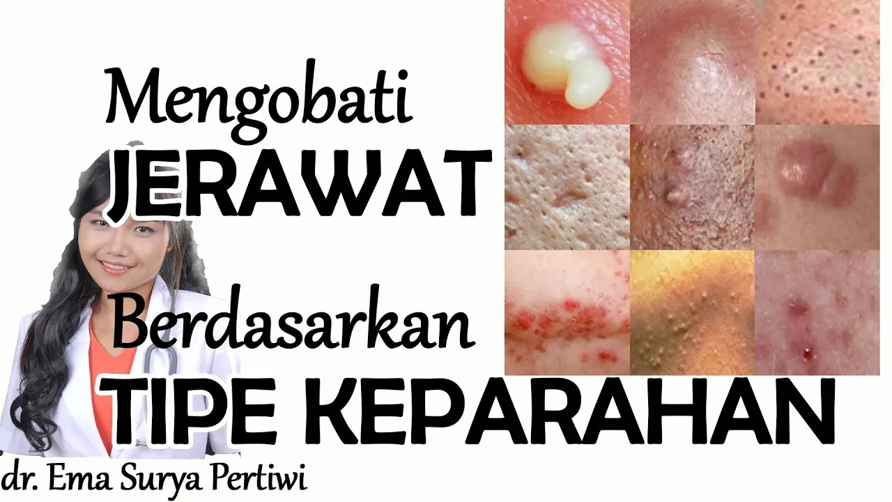 Efektif, Ini Cara Paling Ampuh Menghilangkan Jerawat Batu dengan Skincare!