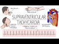 Download Lagu Understanding Supraventricular Tachycardia (SVT)