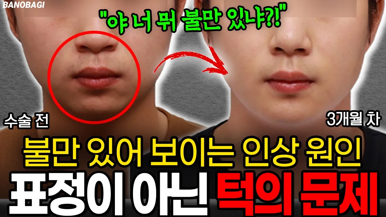 뭐가 바뀐 거야? 자연스럽게 호감상으로 변신💛 뚱한 인상 앞턱 전진술과 볼살 정리로 해결🔥