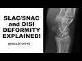 Download Lagu What is SLAC and DISI deformity??