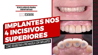 Como Reabilitar os 4 Incisivos Superiores com Implantes de forma PREVISÍVEL?