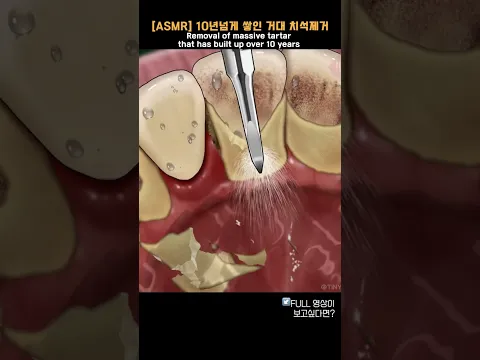 [ASMR] 10년넘게 쌓인 거대 치석제거 / Removal of massive tartar that has built up over 10 years