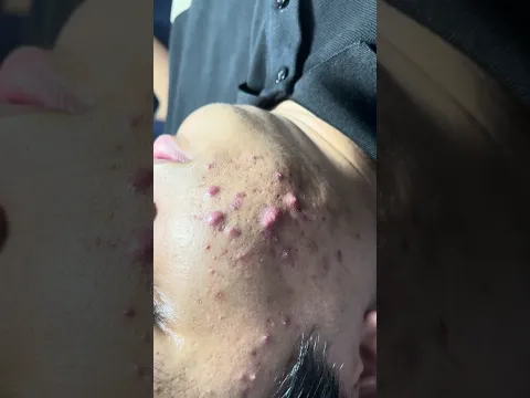 Acne Treatment Huong Da Nan#member#short#Coming soon