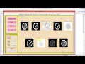 Brain Tumor Detection Using Watershed Technique Matlab Project Code