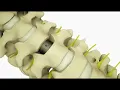 Anterior cervical discectomy and fusion ACDF