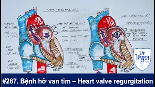 # 287. Bệnh hở van tim triệu chứng và cách chữa trị