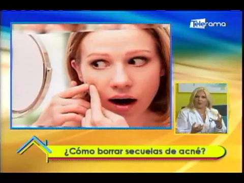 ¿Cómo borrar secuelas de acné?