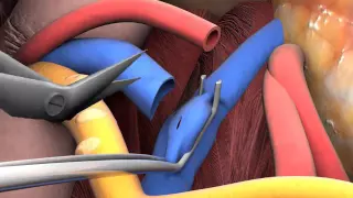 lecture 2 6 kidney transplant surgery