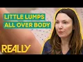 Download Lagu Dr. Emma Removes Multiple Lipomas From Patient’s Arms and Legs | The Bad Skin Clinic