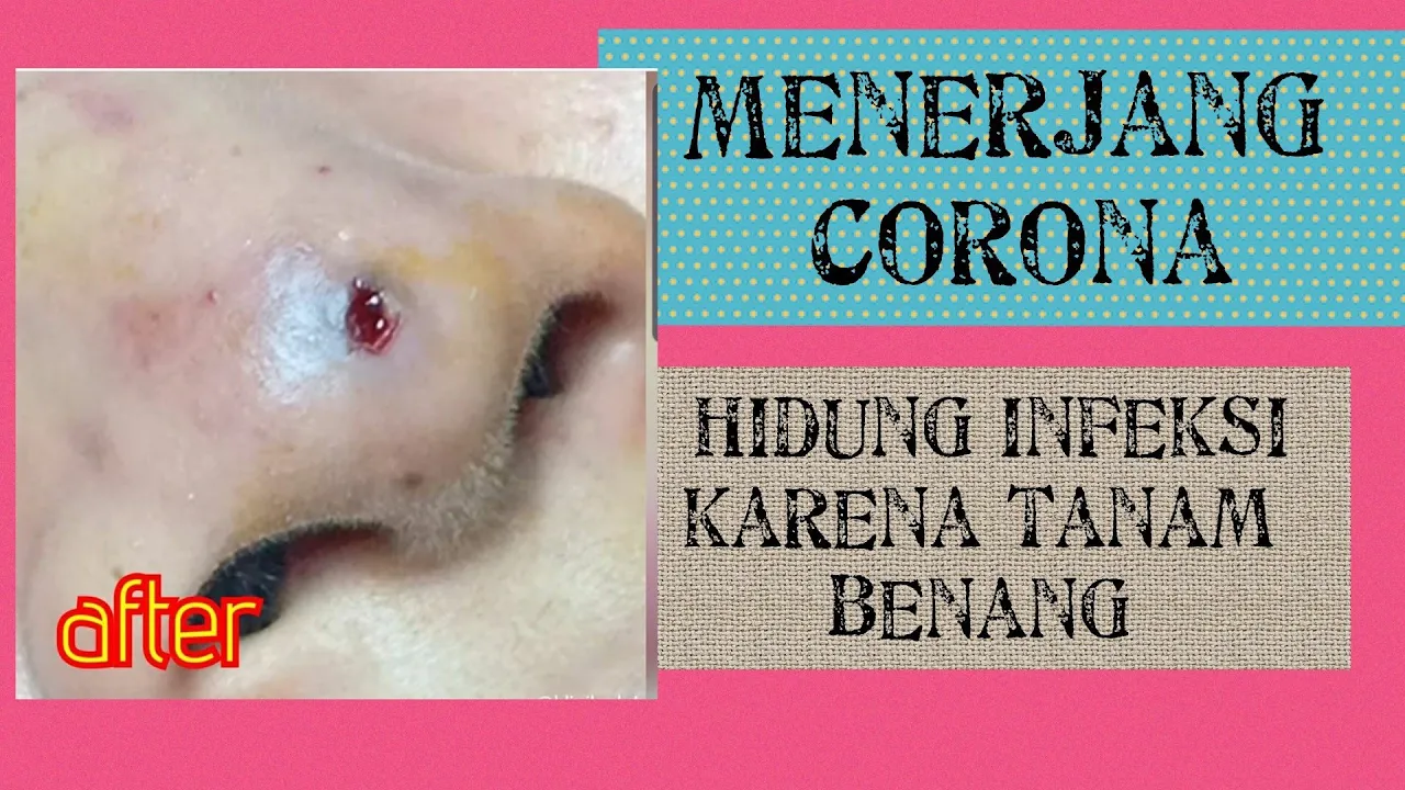 
          
          
          
            
            Menerjang Corona : Hidung Klien Infeksi Karena Tanam Benang | Olivia Rachelina Hans
          
        . 