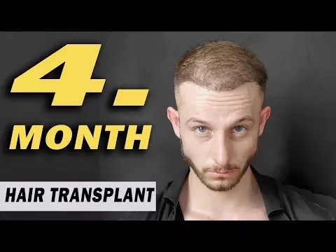 Download MP3 FUE Hair Transplant 4 MONTHS update Istanbul, Turkey