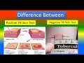 Difference Between Positive TB Skin Test and Negative TB Skin Test