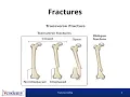 ICD-10-CM Fracture Coding