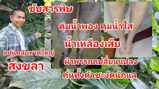 ขับสารพิษตุ่มน้ำพองตุ่มน้ำใสน้ำเหลืองเสียผิวพรรณเปลี่ยน@สมุนไพร #โจฮักนะสารคาม #ลุงโจสมุนไพร EP.1770