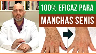 How to Treat? Age Spots on HANDS and FACE [ GUARANTEED ] Sun Spots