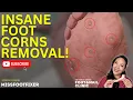 Lagu Removing Multiple Painful Corns | MissFootFixer