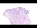 Dermpath educational case 16 6 25 - biopsy from a rash on the face