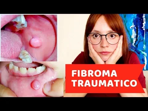 Download MP3 Fibroma Traumático