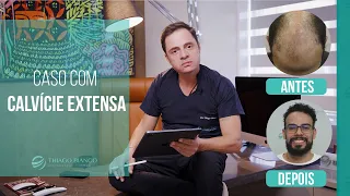 Ele não saía mais sem boné! - Calvície grau 7 | Dr. Thiago Bianco