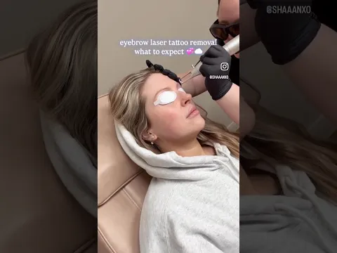 Laser brow tattoo removal! Details and FAQ in description