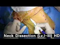 Download Lagu Neck dissection - level I ~ III HD narrative